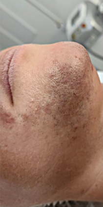 DEPILACJA_LASEROWA-1.1