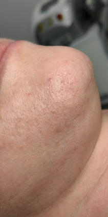 DEPILACJA_LASEROWA-1.2